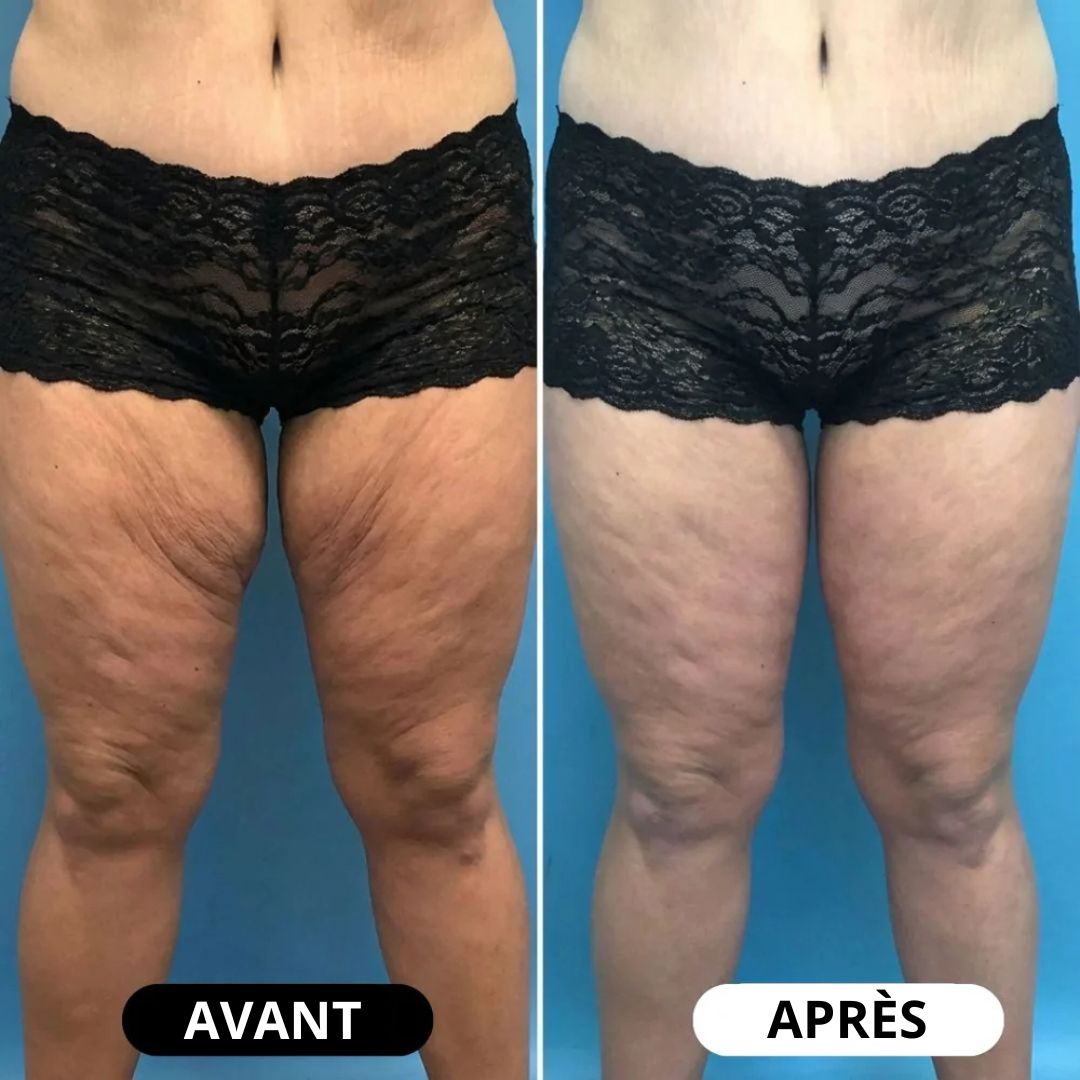 Huile Liftante Anti-Rides Corps